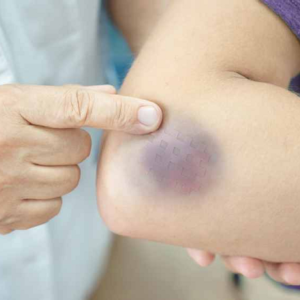 ত্বকের সাধারণ কালো দাগ কি ক্যানসারের শুরু? অবহেলা করলে বড় বিপদ, আজই চিনে নিন লক্ষণ!