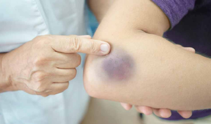 ত্বকের সাধারণ কালো দাগ কি ক্যানসারের শুরু? অবহেলা করলে বড় বিপদ, আজই চিনে নিন লক্ষণ!