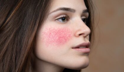 বসন্তের হাওয়ায় ত্বকে র‍্যাশ আর চুলকানি? চটজলদি আরাম পেতে ডায়েটে আনুন এই ৩ বদল!