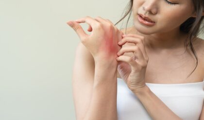 পাউডার ছাড়াই বিদায় হবে ঘামাচি! গরমে চুলকানি ও র‌্যাশ দূর করার ৫টি জাদুকরী টোটকা