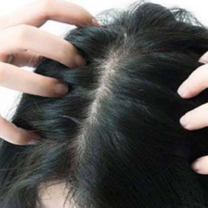 চিরুনি দিলেই মুঠো মুঠো চুল উঠছে? এই ৪টি উপাদানেই হবে টাক সমস্যার সমাধান