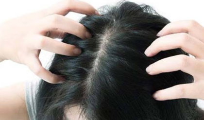 চিরুনি দিলেই মুঠো মুঠো চুল উঠছে? এই ৪টি উপাদানেই হবে টাক সমস্যার সমাধান