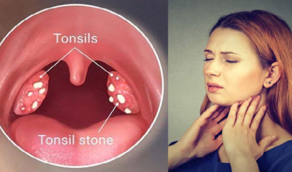 গলায় মারাত্মক ব্যথা? টনসিলকে বিদায় জানান এই ঘরোয়া ম্যাজিকে, মিলবে নিমেষেই আরাম!