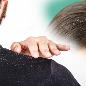 মাথার খুসকি নিয়ে নাজেহাল? শ্যাম্পু নয়, এই ১টি ছোট্ট কৌশলেই হবে কেল্লাফতে!