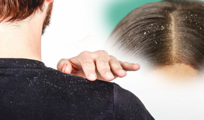 মাথার খুসকি নিয়ে নাজেহাল? শ্যাম্পু নয়, এই ১টি ছোট্ট কৌশলেই হবে কেল্লাফতে!