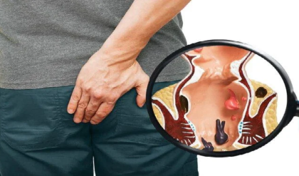 পাইলসের যন্ত্রণায় রাতের ঘুম হারাম? এই ৫ খাবারেই লুকিয়ে আছে ম্যাজিক সমাধান