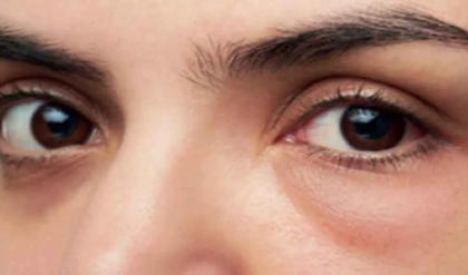 আয়নার সামনে দাঁড়াতে ভয়? চোখের নিচের ফোলাভাব দূর হবে মাত্র ৫ মিনিটে!