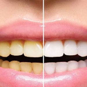 দাঁতের হলদে ছোপ আর মুখের দুর্গন্ধ? বাজারচলতি পেস্ট নয়, নিমডালের এই জাদুকরী ব্যবহারে হবে বাজিমাত!