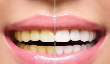 দাঁতের হলদে ছোপ আর মুখের দুর্গন্ধ? বাজারচলতি পেস্ট নয়, নিমডালের এই জাদুকরী ব্যবহারে হবে বাজিমাত!