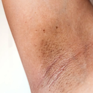 বগলের কালো দাগ নিয়ে নাজেহাল? রান্নাঘরের এই ১টি জিনিস ঘষলেই ম্যাজিকের মতো পরিষ্কার হবে সব দাগ!