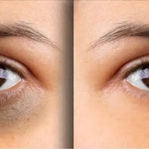 চোখের নিচের কালো দাগ নিয়ে দুশ্চিন্তা? দূর করুন এই ৫টি জাদুকরী ঘরোয়া উপায়ে!