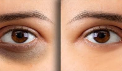 চোখের নিচের কালো দাগ নিয়ে দুশ্চিন্তা? দূর করুন এই ৫টি জাদুকরী ঘরোয়া উপায়ে!