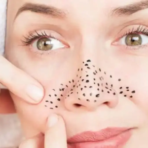 নাকে-মুখে ব্ল্যাকহেডসের উপদ্রব? এই সবজির জাদুকরী ব্যবহারে মুক্তি পান আজই!