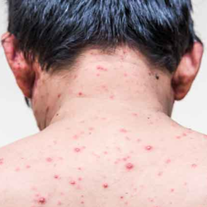 পক্সের জেদি দাগ নিয়ে দুশ্চিন্তা? এই ঘরোয়া উপায়ে ফিরবে ত্বকের স্বাভাবিক উজ্জ্বলতা