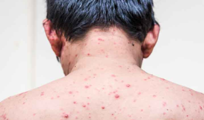 পক্সের জেদি দাগ নিয়ে দুশ্চিন্তা? এই ঘরোয়া উপায়ে ফিরবে ত্বকের স্বাভাবিক উজ্জ্বলতা