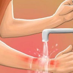 ত্বক পুড়েছে? জ্বালাপোড়া কমাতে হাতের কাছেই পাবেন এই ৩টি ঘরোয়া সমাধান