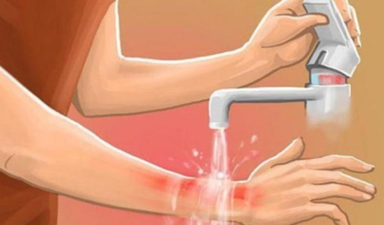 ত্বক পুড়েছে? জ্বালাপোড়া কমাতে হাতের কাছেই পাবেন এই ৩টি ঘরোয়া সমাধান