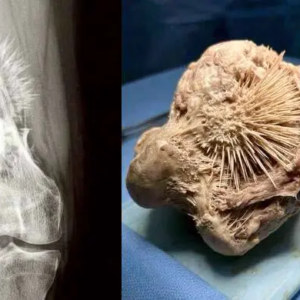 হাড়ের সাধারণ ব্যথা ভেবে ভুল করছেন না তো? এক্স-রে রিপোর্টে ‘সূর্যের কিরণ’ দেখা দিলেই বুঝবেন বিপদ! হাড়ের সাধারণ ব্যথা ভেবে ভুল করছেন না তো? এক্স-রে রিপোর্টে ‘সূর্যের কিরণ’ দেখা দিলেই বুঝবেন বিপদ!