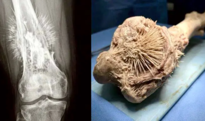 হাড়ের সাধারণ ব্যথা ভেবে ভুল করছেন না তো? এক্স-রে রিপোর্টে ‘সূর্যের কিরণ’ দেখা দিলেই বুঝবেন বিপদ!