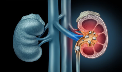 সাবধান! রোজকার এই ৫টি খাবারই কি আপনার কিডনিতে পাথর জমাচ্ছে? আজই সতর্ক হোন সাবধান! রোজকার এই ৫টি খাবারই কি আপনার কিডনিতে পাথর জমাচ্ছে? আজই সতর্ক হোন