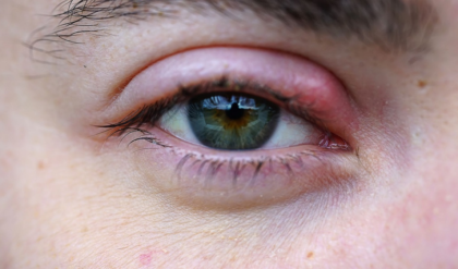 চোখে বারবার অঞ্জনি হচ্ছে? ড্রপ বা ওষুধের আগে এই ঘরোয়া টোটকা ট্রাই করুন, ফল পাবেন হাতে-নাতে! চোখে বারবার অঞ্জনি হচ্ছে? ড্রপ বা ওষুধের আগে এই ঘরোয়া টোটকা ট্রাই করুন, ফল পাবেন হাতে-নাতে!