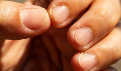 সাবধান! দাঁত দিয়ে নখ কাটেন? অজান্তেই ডেকে আনছেন পঙ্গুত্ব, বাদ যেতে পারে আঙুল!