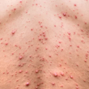 হাম বা পক্সের যন্ত্রণায় নাজেহাল? দ্রুত সেরে উঠতে ডায়েটে যোগ করুন এই ৫টি খাবার!