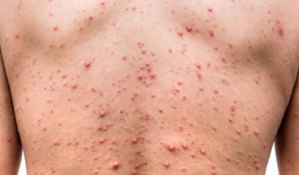 হাম বা পক্সের যন্ত্রণায় নাজেহাল? দ্রুত সেরে উঠতে ডায়েটে যোগ করুন এই ৫টি খাবার!