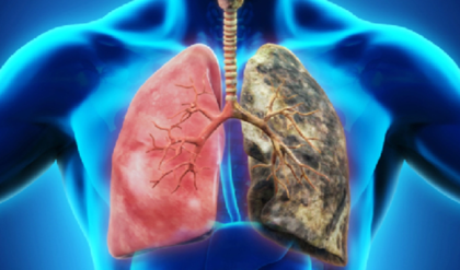 নিশ্বাসে বিষ? ফুসফুসকে লোহার মতো শক্ত করতে আজই ডায়েটে যোগ করুন এই ৫টি ফল!