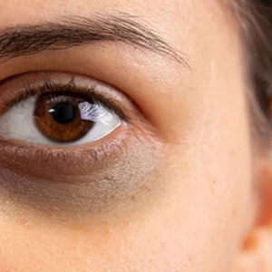 চোখের নিচের জেদি কালো দাগ নিয়ে চিন্তিত? মাত্র ৭ দিনে ডার্ক সার্কেল দূর করার ৫টি জাদুকরী ঘরোয়া উপায়!