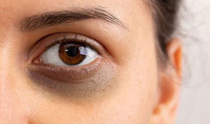 চোখের নিচের জেদি কালো দাগ নিয়ে চিন্তিত? মাত্র ৭ দিনে ডার্ক সার্কেল দূর করার ৫টি জাদুকরী ঘরোয়া উপায়! চোখের নিচের জেদি কালো দাগ নিয়ে চিন্তিত? মাত্র ৭ দিনে ডার্ক সার্কেল দূর করার ৫টি জাদুকরী ঘরোয়া উপায়!