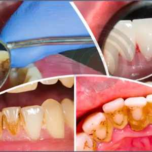 দাঁতের হলদেটে স্তর বা প্লাক নিয়ে লজ্জিত? ঘরে থাকা এই ৫টি জিনিস ব্যবহারেই ফিরবে মুক্তোর মতো ঝকঝকে হাসি!