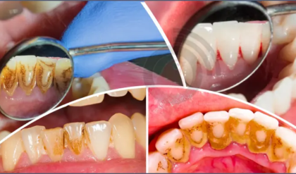 দাঁতের হলদেটে স্তর বা প্লাক নিয়ে লজ্জিত? ঘরে থাকা এই ৫টি জিনিস ব্যবহারেই ফিরবে মুক্তোর মতো ঝকঝকে হাসি! দাঁতের হলদেটে স্তর বা প্লাক নিয়ে লজ্জিত? ঘরে থাকা এই ৫টি জিনিস ব্যবহারেই ফিরবে মুক্তোর মতো ঝকঝকে হাসি!