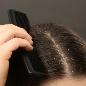 চুল পড়া থামছে না খুশকির কারণে? এই প্রাকৃতিক উপায়ে মাত্র ৭ দিনেই পান জেল্লাদার স্ক্যাল্প