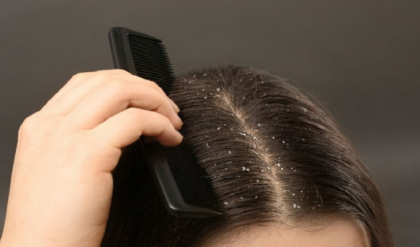 চুল পড়া থামছে না খুশকির কারণে? এই প্রাকৃতিক উপায়ে মাত্র ৭ দিনেই পান জেল্লাদার স্ক্যাল্প