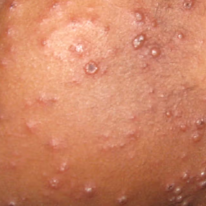 চিকেনপক্স না কি হাম? একই রকম দেখতে হলেও জীবন বাঁচাতে জেনে নিন এই দুই রোগের আসল পার্থক্য!