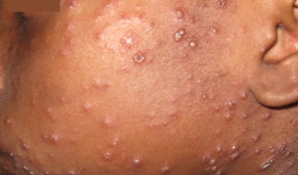 চিকেনপক্স না কি হাম? একই রকম দেখতে হলেও জীবন বাঁচাতে জেনে নিন এই দুই রোগের আসল পার্থক্য! চিকেনপক্স না কি হাম? একই রকম দেখতে হলেও জীবন বাঁচাতে জেনে নিন এই দুই রোগের আসল পার্থক্য!