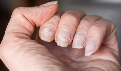 নখ কি বারবার ভেঙে যাচ্ছে? এই ৫টি ঘরোয়া টোটকায় নখ হবে হিরের মতো শক্ত!