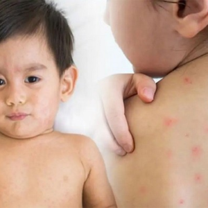 হঠাৎ হামের আক্রমণ? আতঙ্কিত না হয়ে দ্রুত সুস্থ হতে যা যা করা জরুরি হঠাৎ হামের আক্রমণ? আতঙ্কিত না হয়ে দ্রুত সুস্থ হতে যা যা করা জরুরি