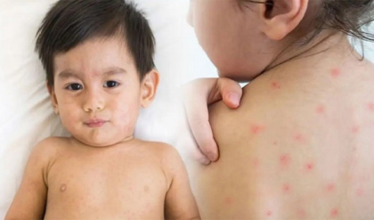 হঠাৎ হামের আক্রমণ? আতঙ্কিত না হয়ে দ্রুত সুস্থ হতে যা যা করা জরুরি