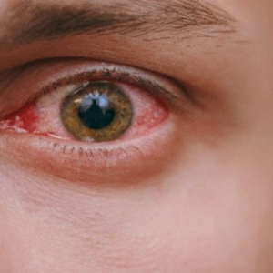 চোখ ওঠা ব্যক্তির দিকে তাকালেই কি আপনারও চোখ উঠবে? জানুন বিজ্ঞানের আসল উত্তর!