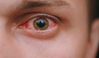 চোখ ওঠা ব্যক্তির দিকে তাকালেই কি আপনারও চোখ উঠবে? জানুন বিজ্ঞানের আসল উত্তর!