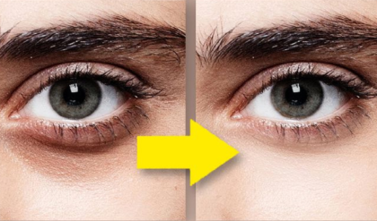 চোখের নিচে কালচে দাগ? মাত্র ৩টি সহজ উপায়ে পান উজ্জ্বল ত্বক!