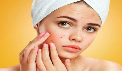 মাত্র ৭ দিনে মুখের জেদি কালো দাগ উধাও! আজই ট্রাই করুন এই সিক্রেট টিপস