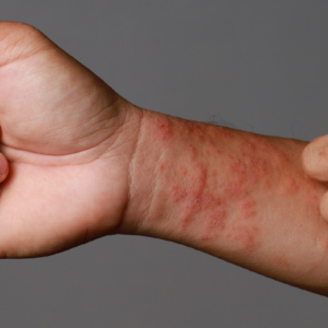 অ্যাকজিমার চুলকানিতে অতিষ্ঠ? এই ঘরোয়া টোটকাতেই মিলবে চিরস্থায়ী মুক্তি!