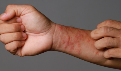 অ্যাকজিমার চুলকানিতে অতিষ্ঠ? এই ঘরোয়া টোটকাতেই মিলবে চিরস্থায়ী মুক্তি!