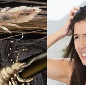 মাথার উকুন নিয়ে নাজেহাল? কেমিক্যাল ছেড়ে এই ৩টি ঘরোয়া টোটকাতেই হবে বাজিমাত!