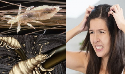 মাথার উকুন নিয়ে নাজেহাল? কেমিক্যাল ছেড়ে এই ৩টি ঘরোয়া টোটকাতেই হবে বাজিমাত!