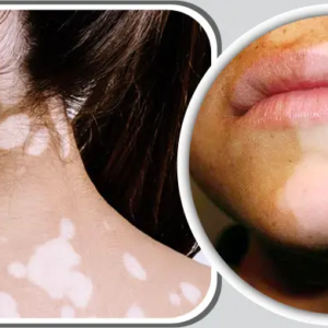 ত্বকের সাদা ছোপ বা ছুলি নিয়ে দুশ্চিন্তা? ঔষধ ছাড়াই দূর হবে জেদি দাগ, শুধু মেনে চলুন এই ঘরোয়া উপায়!