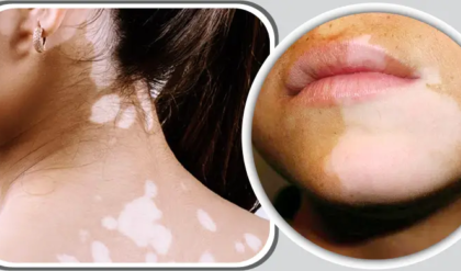 ত্বকের সাদা ছোপ বা ছুলি নিয়ে দুশ্চিন্তা? ঔষধ ছাড়াই দূর হবে জেদি দাগ, শুধু মেনে চলুন এই ঘরোয়া উপায়!